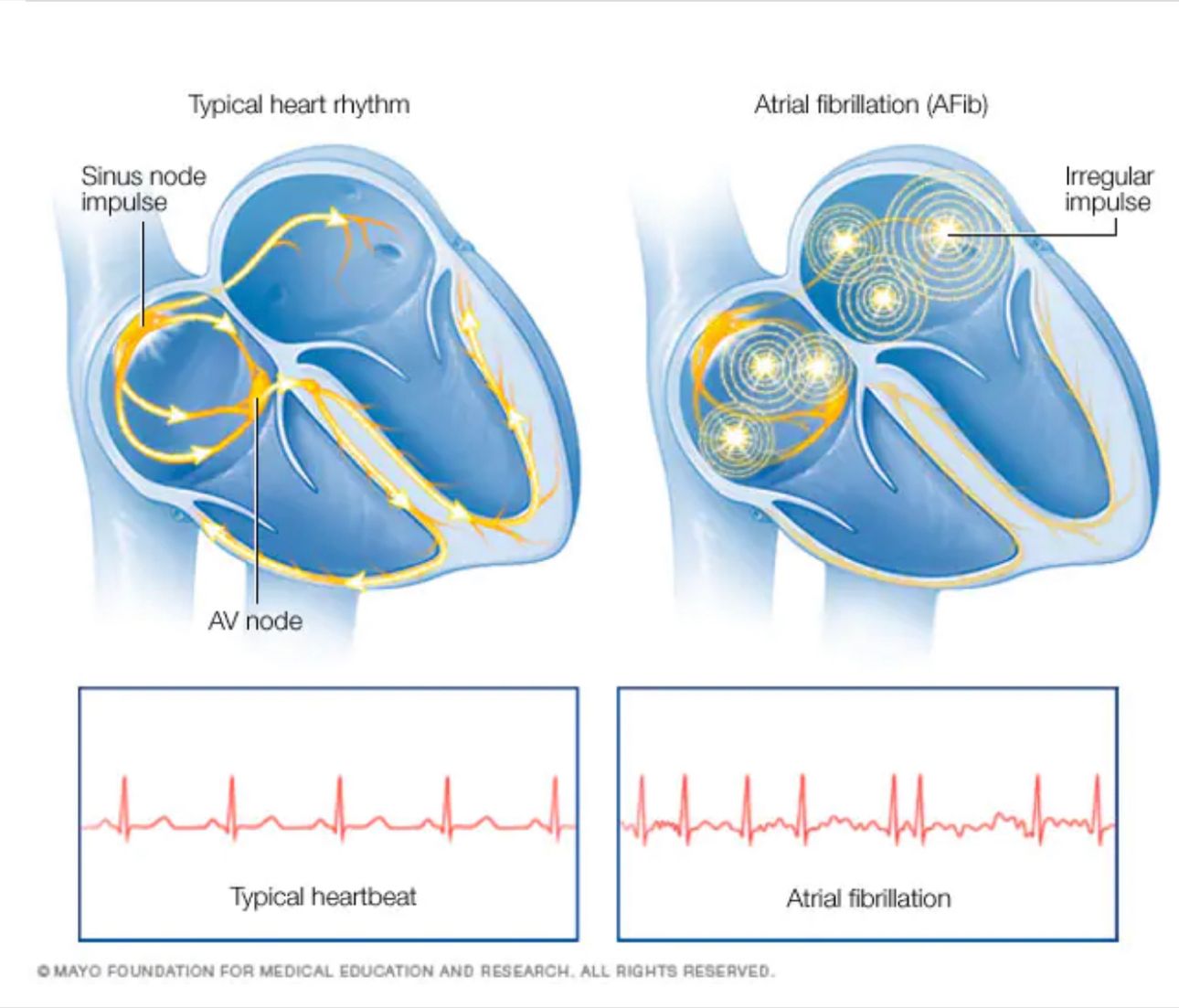 AFib